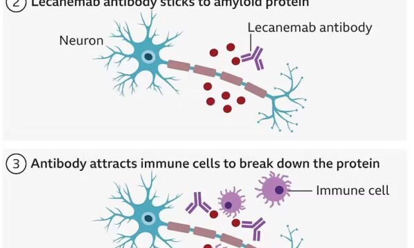 New Alzheimer Drug