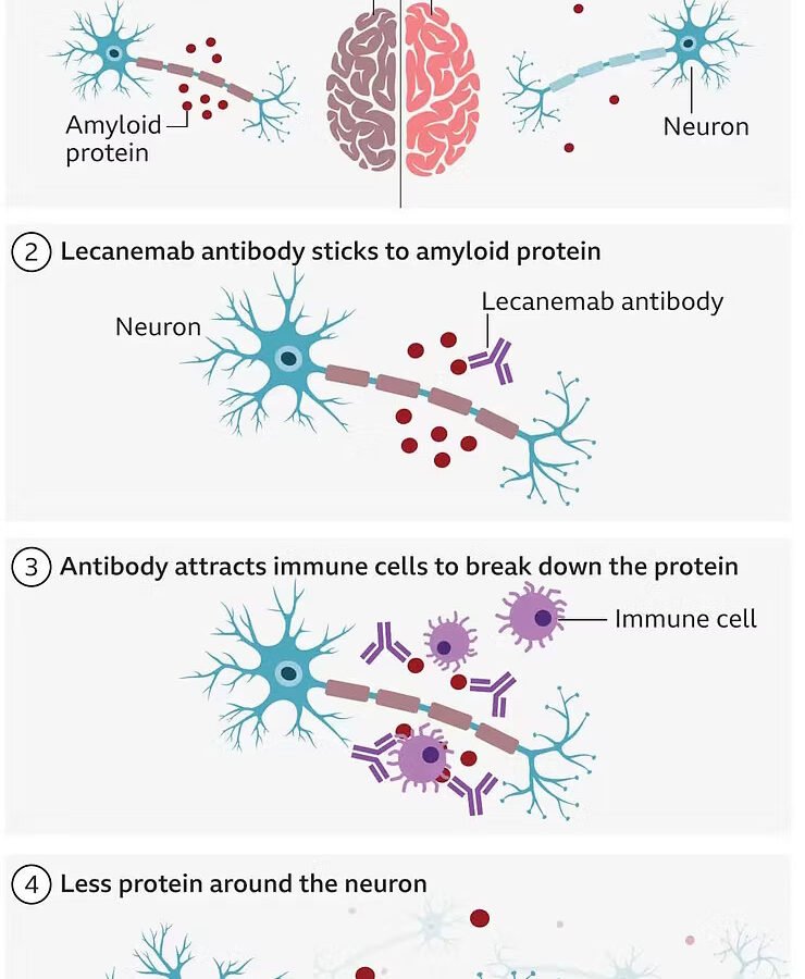 New Alzheimer Drug